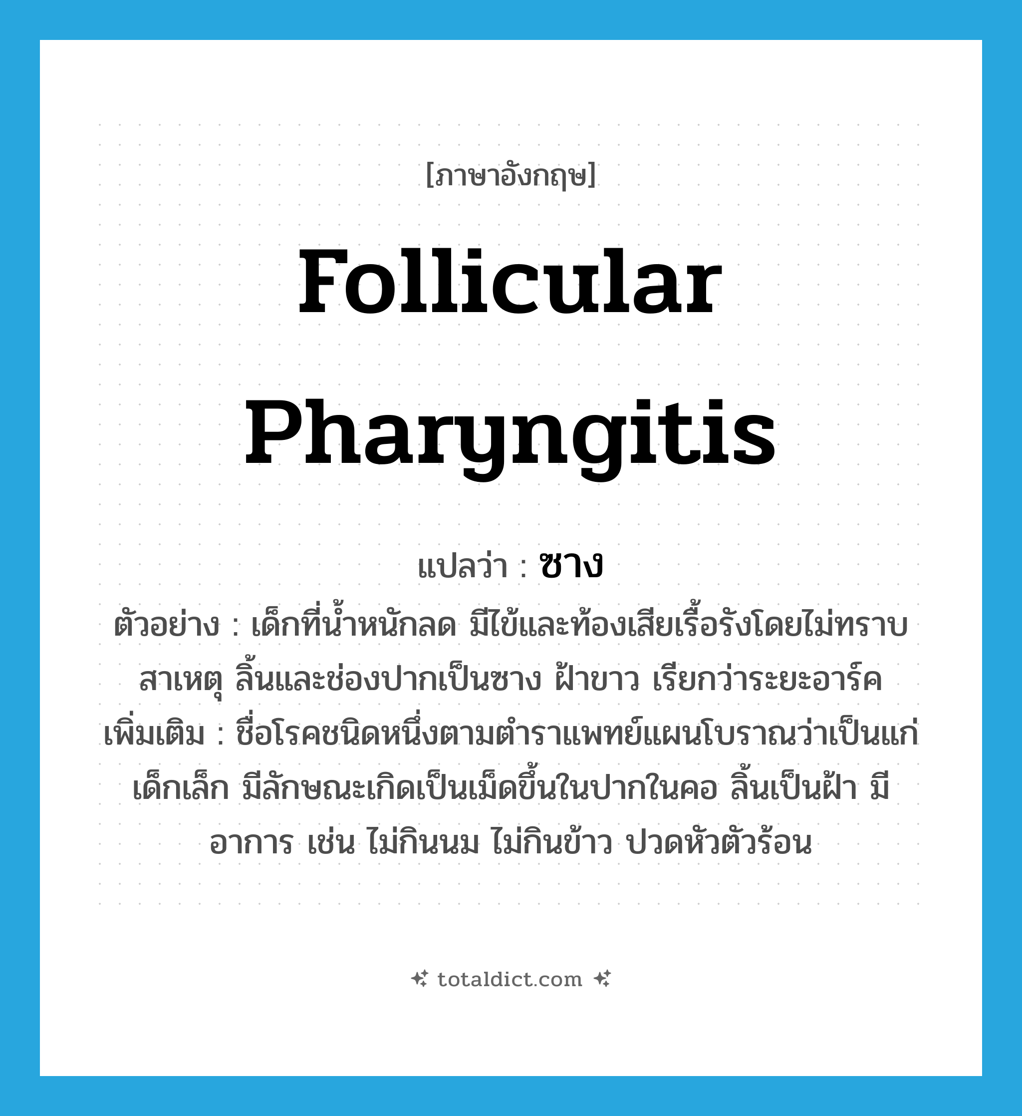 follicular pharyngitis แปลว่า?, คำศัพท์ภาษาอังกฤษ follicular pharyngitis แปลว่า ซาง ประเภท N ตัวอย่าง เด็กที่น้ำหนักลด มีไข้และท้องเสียเรื้อรังโดยไม่ทราบสาเหตุ ลิ้นและช่องปากเป็นซาง ฝ้าขาว เรียกว่าระยะอาร์ค เพิ่มเติม ชื่อโรคชนิดหนึ่งตามตำราแพทย์แผนโบราณว่าเป็นแก่เด็กเล็ก มีลักษณะเกิดเป็นเม็ดขึ้นในปากในคอ ลิ้นเป็นฝ้า มีอาการ เช่น ไม่กินนม ไม่กินข้าว ปวดหัวตัวร้อน หมวด N